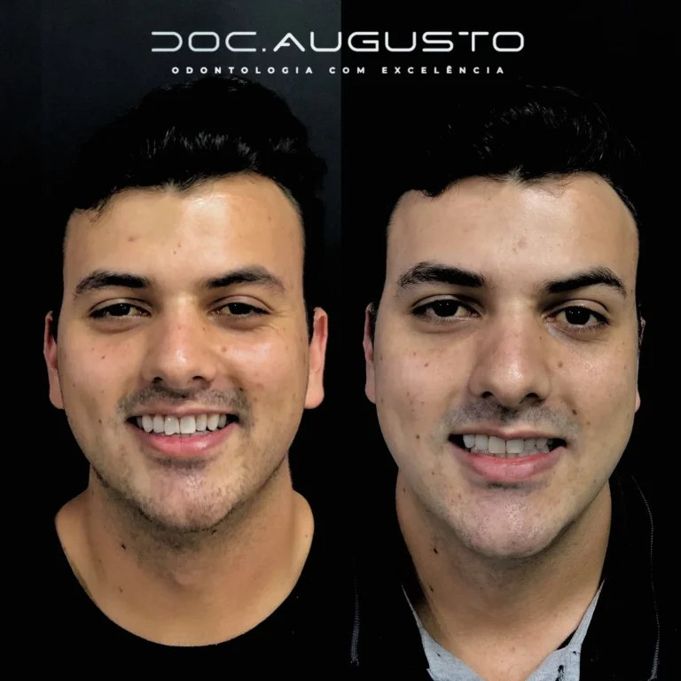 Antes e depois