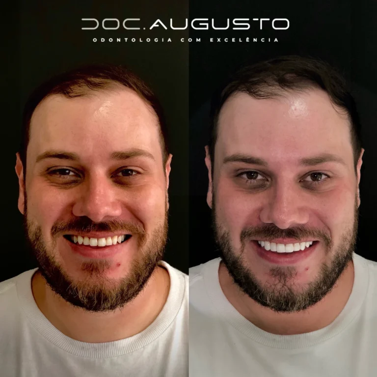 Antes e depois