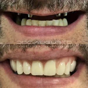 Implantes Dentários