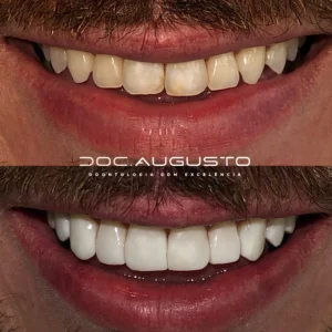 Lentes de contato dental